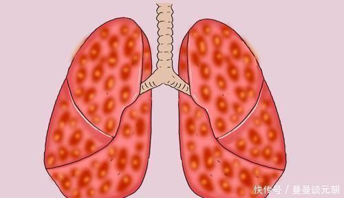 非小细胞癌|得了肺癌，究竟还能活多久熬过五年生存期，是不是就安全了