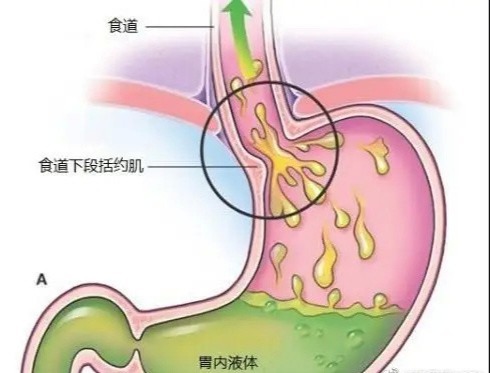 油炸食物|胃酸过多注意不宜的食物