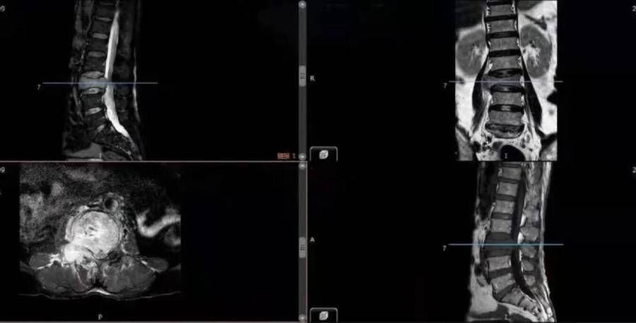 椎体|烟台山医院成功完成全脊柱肿瘤切除＋3D打印人工椎体置换术