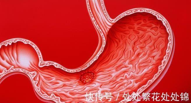 口臭|幽门螺杆菌“克星”找到了,你若爱喝,肠胃好好的,口臭也没影了