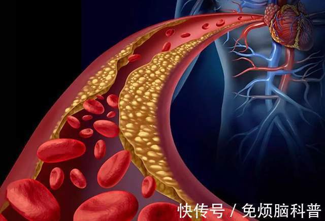 长寿|高血脂患者,饮食要坚持一疏二控三消耗,避免并发症,才能更长寿