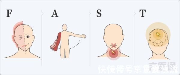 缺血性脑卒中|世纪坛专家:头晕、走路像踩棉花是怎么回事?