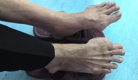 一张只有2味药的痛风治愈方,造福了无数人,从根本上解决痛风