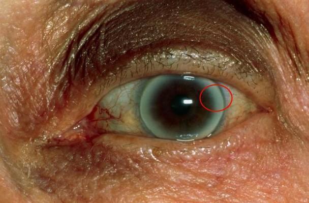 眼角膜|血脂高不高，看脸如果脸上有4种表现，要注意降低血脂了