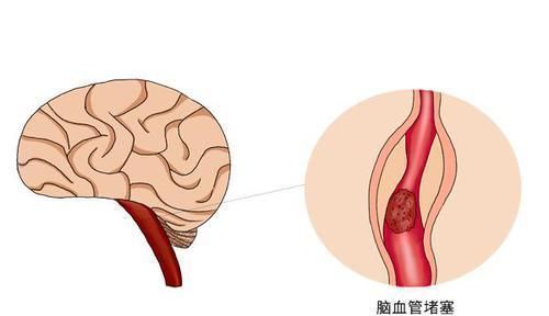 脑供血不足|经常头晕,是不是“脑供血不足”?医生告诉你:真不是