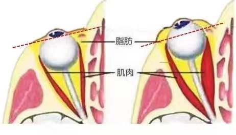 加班、熬夜、生闷气……22岁女生眼肿成“金鱼眼”！|深晚报道 | 甲亢