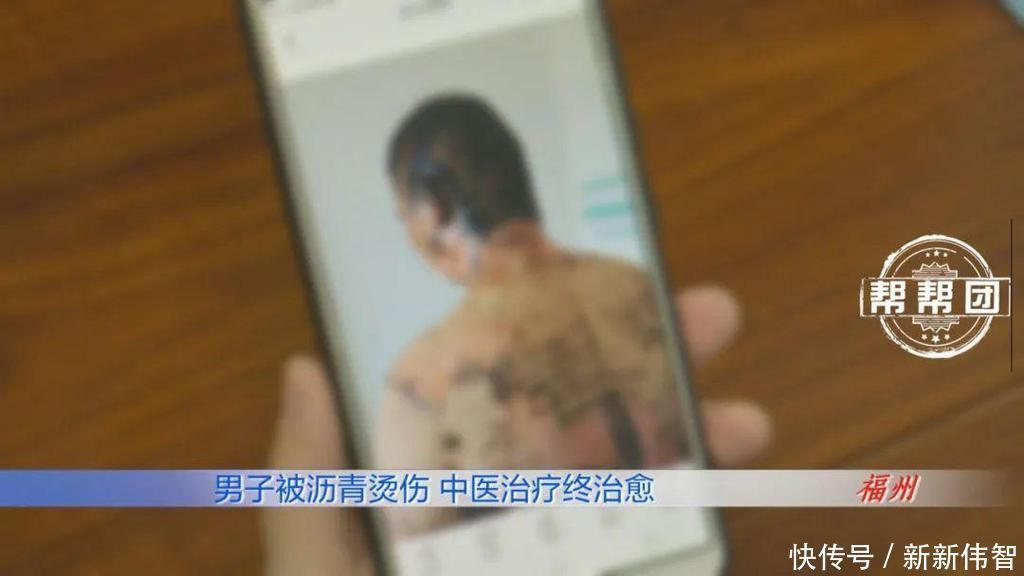 惊心!滚烫的沥青从头浇下,男子全身多处遭遇严重烧烫伤