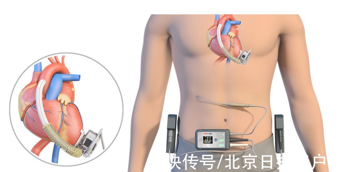 心脏衰竭|打破国外垄断格局，首个国产全磁悬浮人工心脏上市