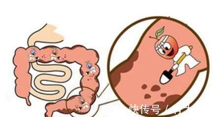 大便|严重便秘怎么办 肠道的“清洁工”来了, 轻松排出体内宿便!