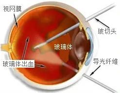 视网膜病变|“糖网”不是“网”，严重可致盲！