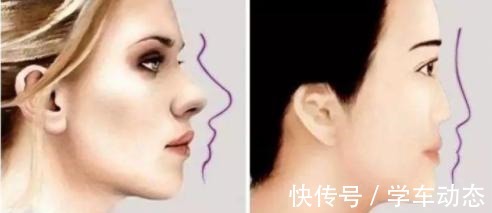 眉骨处 医美避坑理性变美,五大理由拒绝假体眉弓骨!