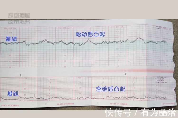 宫缩|孕妇都需要做的“胎心监护图”是啥？你会看那张图吗？其实很简单
