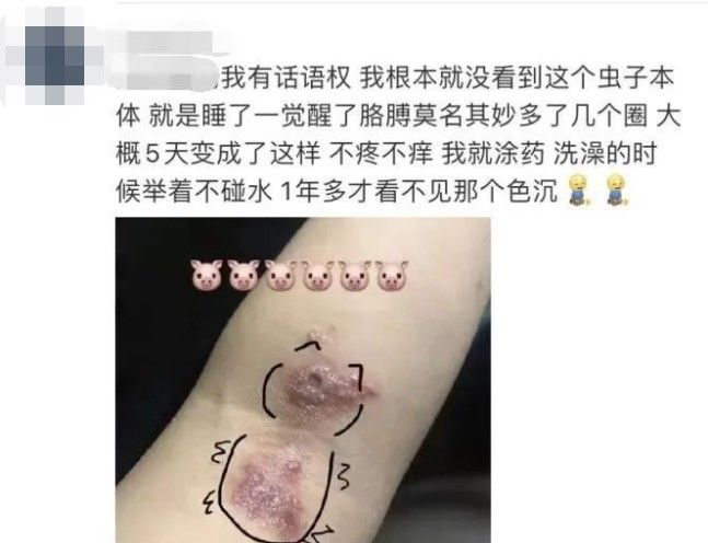 隐翅虫|又是它!女子半夜关灯玩手机,险些致毁容……