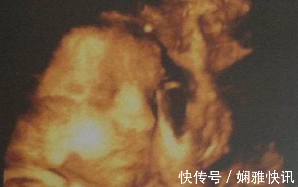 小聆|7个月孕妈去产检,发现胎儿“捂鼻子”,了解情况后医生怒斥孕妈