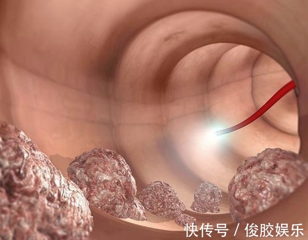 白领|32岁女白领查出肠癌离世，医生解释两个习惯害的