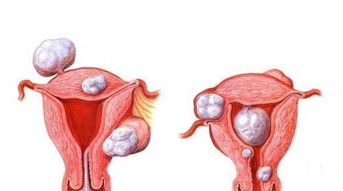 专门对付囊肿肌瘤的3大剑客!让你免去挨刀之苦,绝对值得收藏!