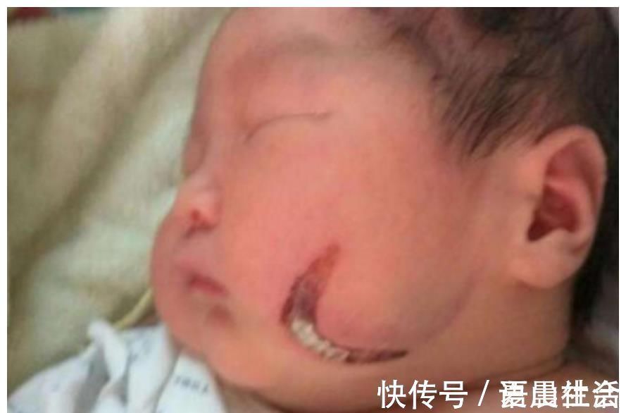 印记|宝宝脸上“产钳印”未消除，婆婆开启“责怪模式”，宝妈好心塞！