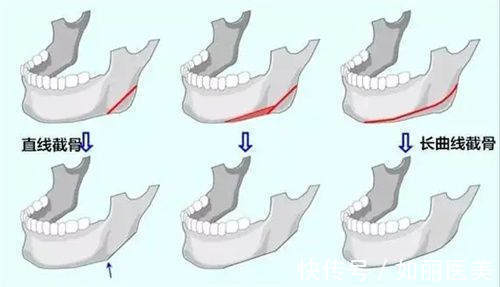 切除 下颌角削骨后有哪些后遗症?术后需要注意事项有哪些