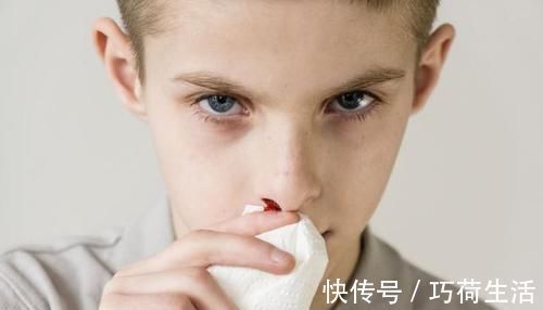 压迫止血法|宝宝容易流鼻血,父母不要再用纸巾塞鼻孔了,用其它的方法止血
