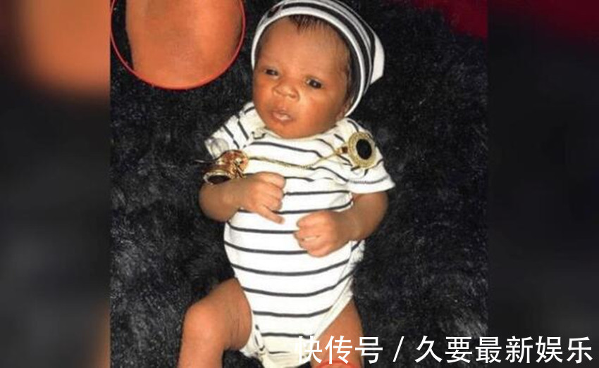 姐姐|姐姐在腹中被弟弟“吸收”,变成胎记留弟弟腿上,网友最美胎记