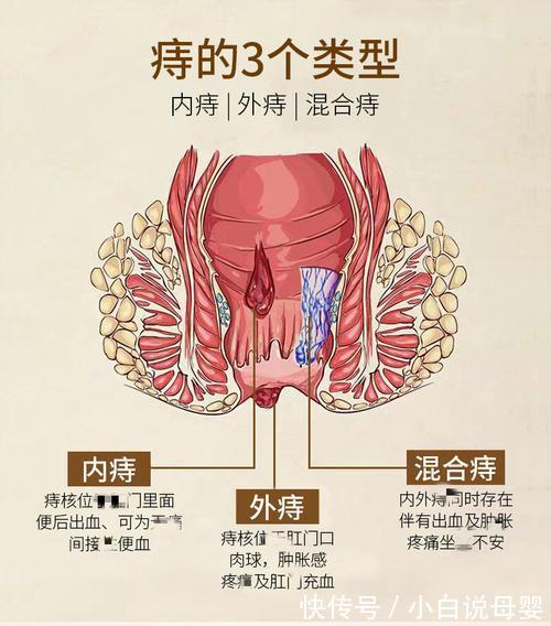便血|怎么让痔疮缩回去？专家：想要痔疮早点消失？正确用药才是关键！