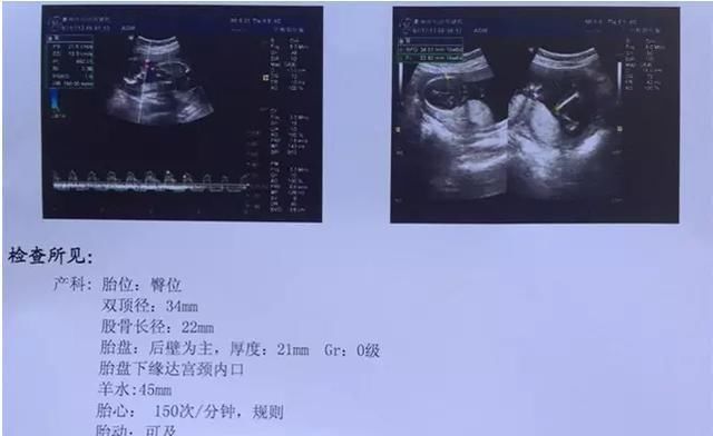 怀孕四个月怀男孩胎动