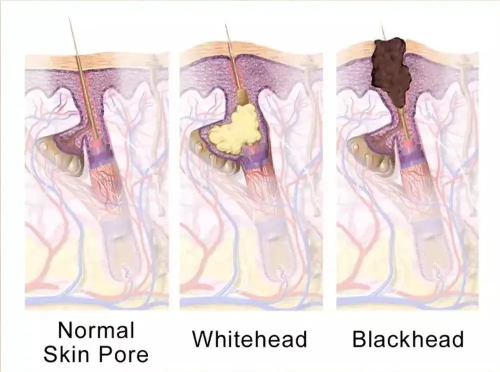 油脂|女生别再这样去黑头了，会越来越丑