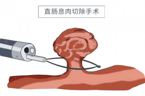 直肠癌|46岁拖到52岁，肠息肉终于“熬成”直肠癌，提醒：息肉要趁早切