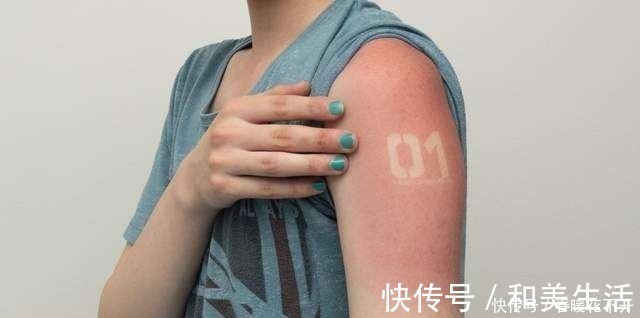 晒伤|日本宅男COS初音被严重晒伤,去年的教训只记得一半的下场