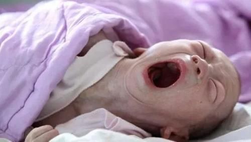 麻药|孕妇剖腹产打麻药不管用,得知原因后,丈夫想离婚