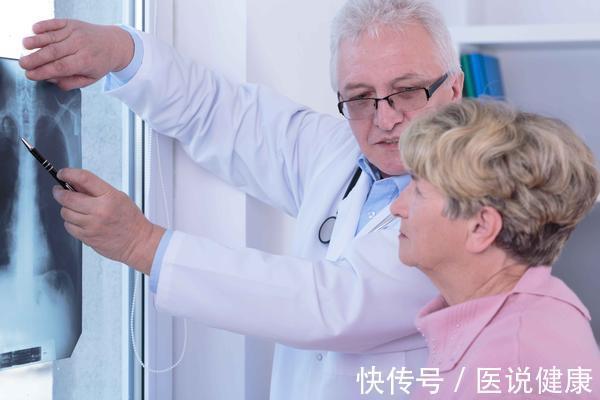 结节|查出肺部结节,担心会癌变?医生表示:看完这3点你就明白了