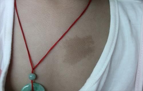 色素|孕期这些行为,会给你的孩子带来“印记”,孕妈可别忽视