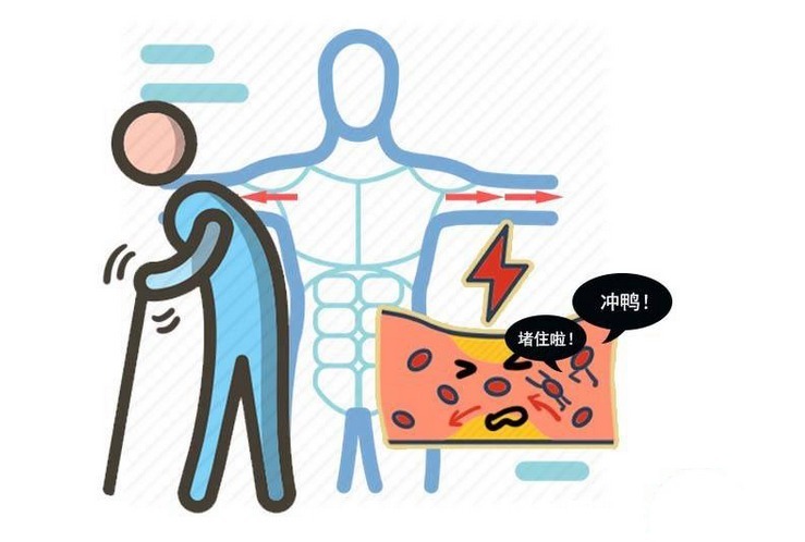 大脑|脑供血不足有典型人群?6类人格外注意,身体出现异常,尽快排查