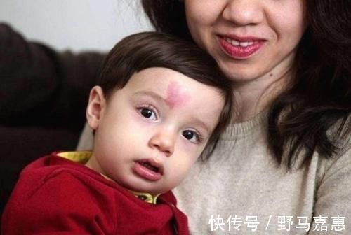 产科大夫|胎记是怎么来的?产科大夫:天生的除外,孕期这3种行为尽量避开