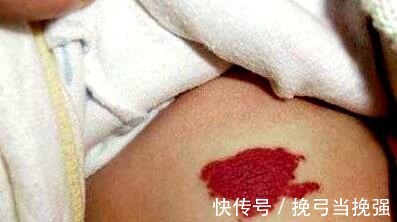 家长|一岁宝宝因“胎记”抢救无效,永远闭上了眼,家长不容忽视!