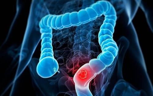 狭窄者|做肠镜的好处有哪些？提醒：以下“3类”人群或不适合做肠镜检查