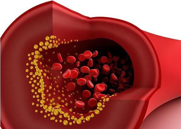 医生|每天担心胆固醇高?医生:是因为你不了解它,其实很好控制