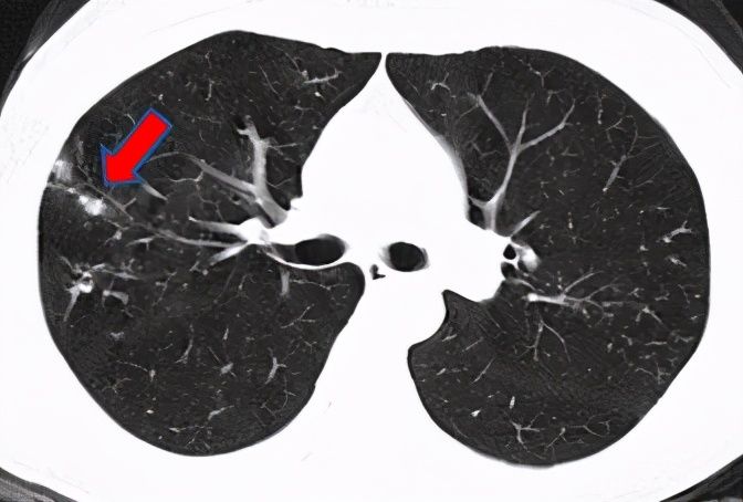 结节|刀下“留肺”!容易误认为癌性“肺结节”的8种感染