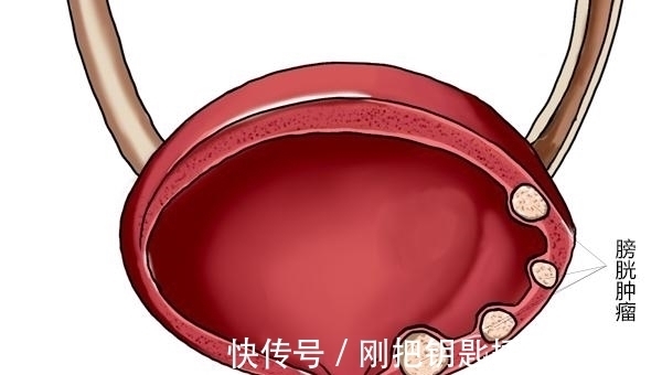 排出体外|小便时，尿液中有很多泡沫，味道还很重，是什么原因？