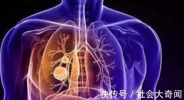 茄子|茄子是肺结节“发物”?医生提醒:想要肺稳定,3种食物要少吃