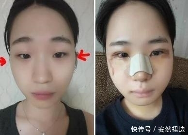 小脸确实更可爱,看完整容过程,只觉得满屏的疼痛