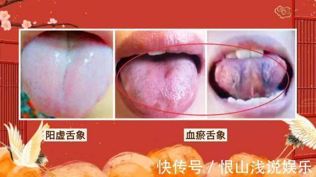 黑豆|血瘀生百病！中医推荐4个活血化瘀宝贝，针对不同的血瘀体质！