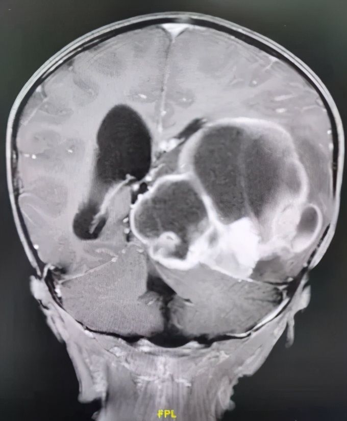 折翼天使们|2岁就查出肿瘤！这些让人心疼的折翼天使们，后来怎么样了？