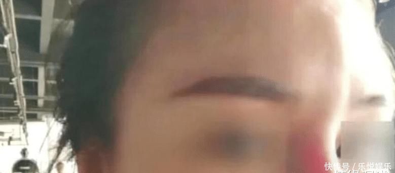 想要鼻子更秀气一点,术后竟然像“果冻”,女子吓得不敢出门