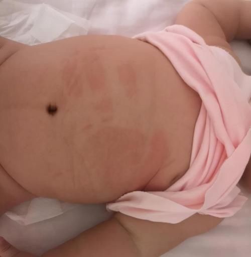 中药|5岁女童因喝水积食,查出“脾胃衰竭”,出现4种表现,就得注意了