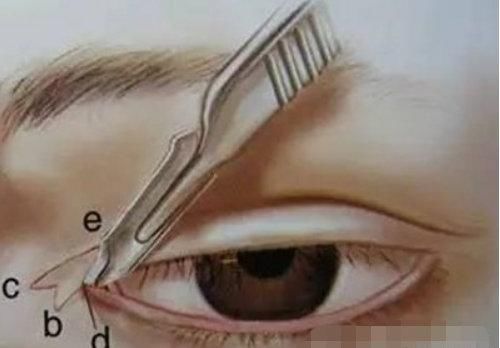 想开眼角又担心留疤，开眼角疤痕增生多久会消失？