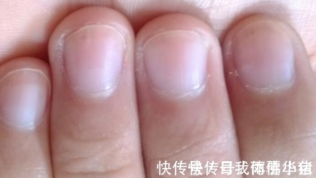 肝炎|指甲3种“现象”,可能是肝不好了,小心肝炎、肝硬化上门来