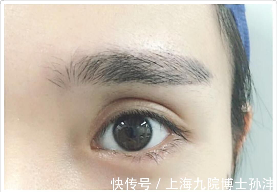 双眼皮手术 双眼皮手术后,眼型看起来圆了真的好看吗?