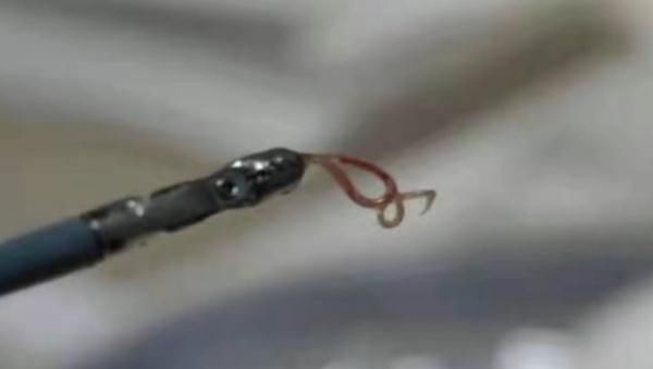 男子腹痛难忍,肠道中夹出8条活虫