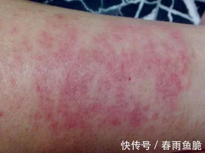 湿疹治疗方法